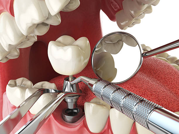 Best Emergency Dental Surgery in Hanover, OH